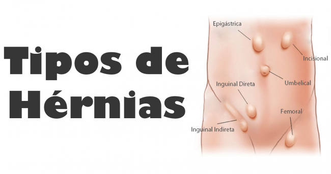 hernias