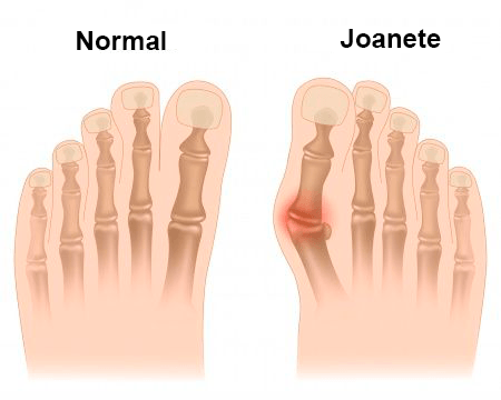 Joanete - Hallux Valgus - Lojas de Ortopedia e Geriatria