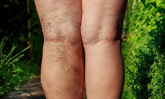varicoseVeins